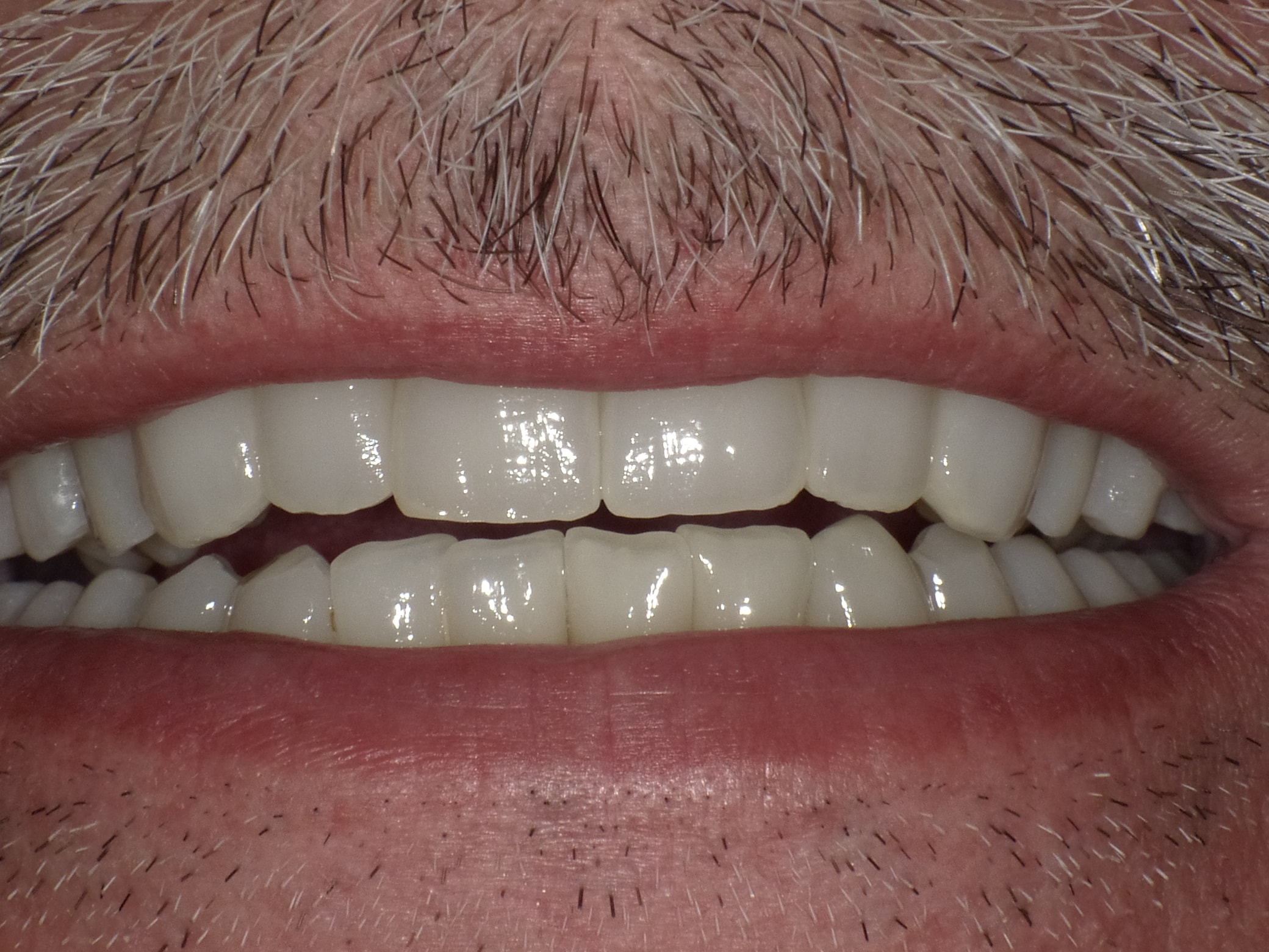 Gesamtbehandlung in Sedierung: die Seitenzähne wurden durch Keramik-Implantate (Zahnentfernungen und Sofortimplantation) mit Knochenaufbau ersetzt; anschließend Gesamtüberkronung aus Vollkeramik mit Optimierung der Ästhetik
